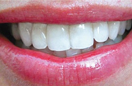 Teeth 03 sm