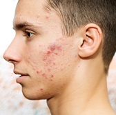 cystic acne